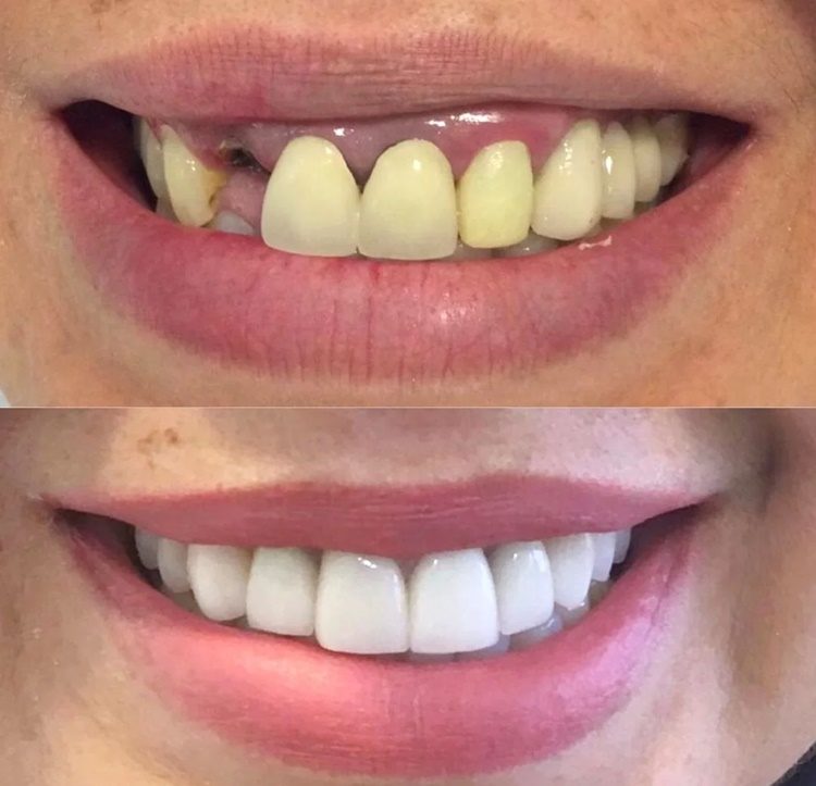 implante-dentario-antes-e-depois01