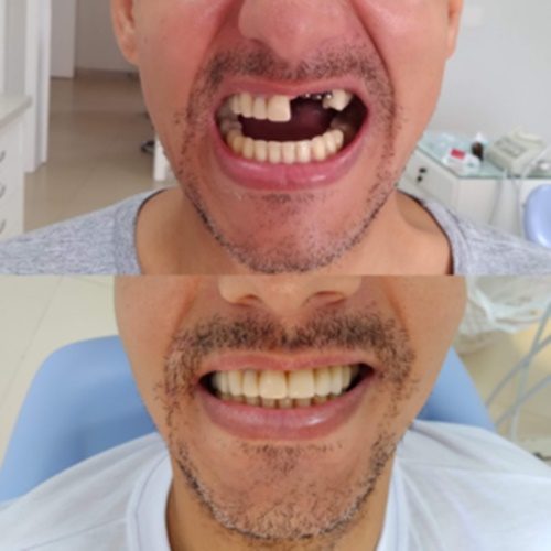 implante-dentario-antes-e-depois02