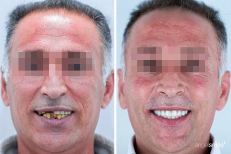 implante-dentario-antes-e-depois03-1