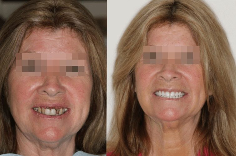 implante-dentario-antes-e-depois04