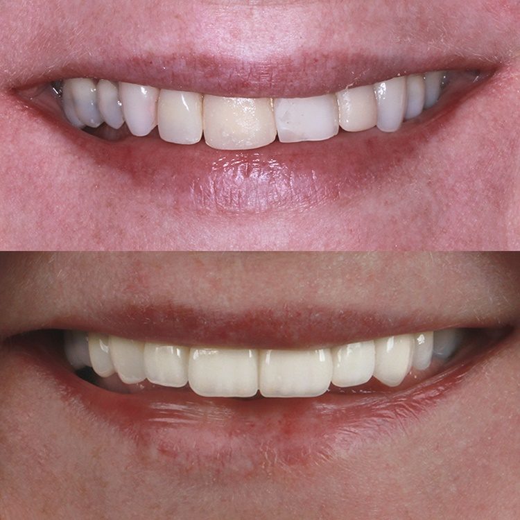 implante-dentario-antes-e-depois06